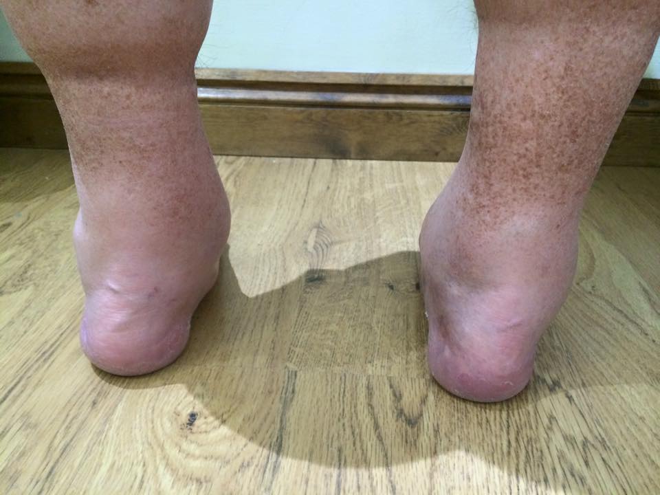 Arthritis & Foot Health Kent Foot & Ankle Clinic