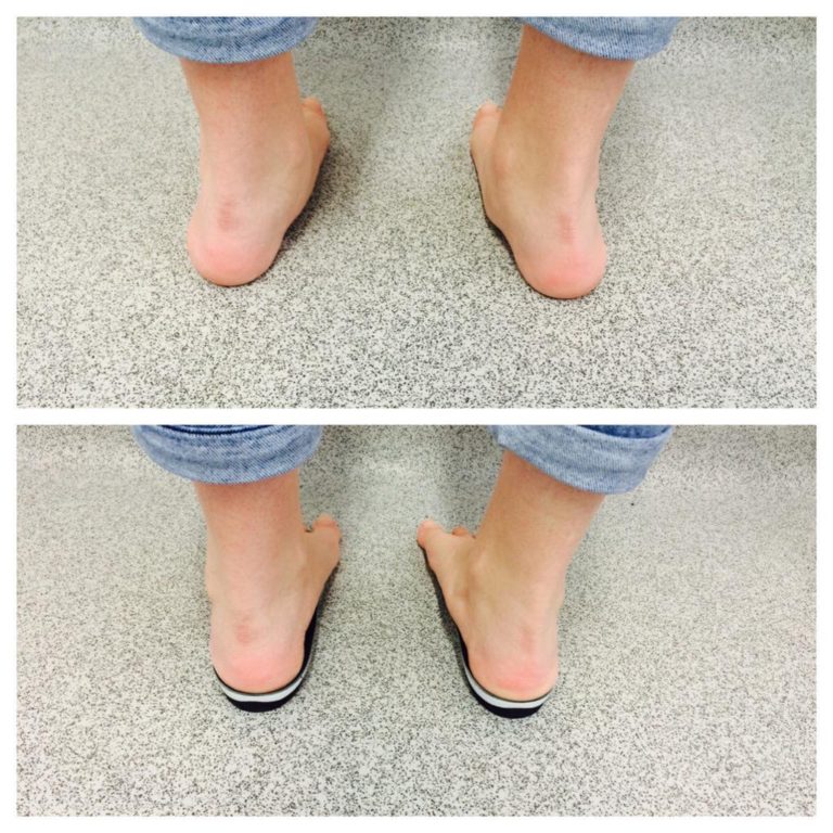 Insoles & Orthotics Kent Foot & Ankle Clinic