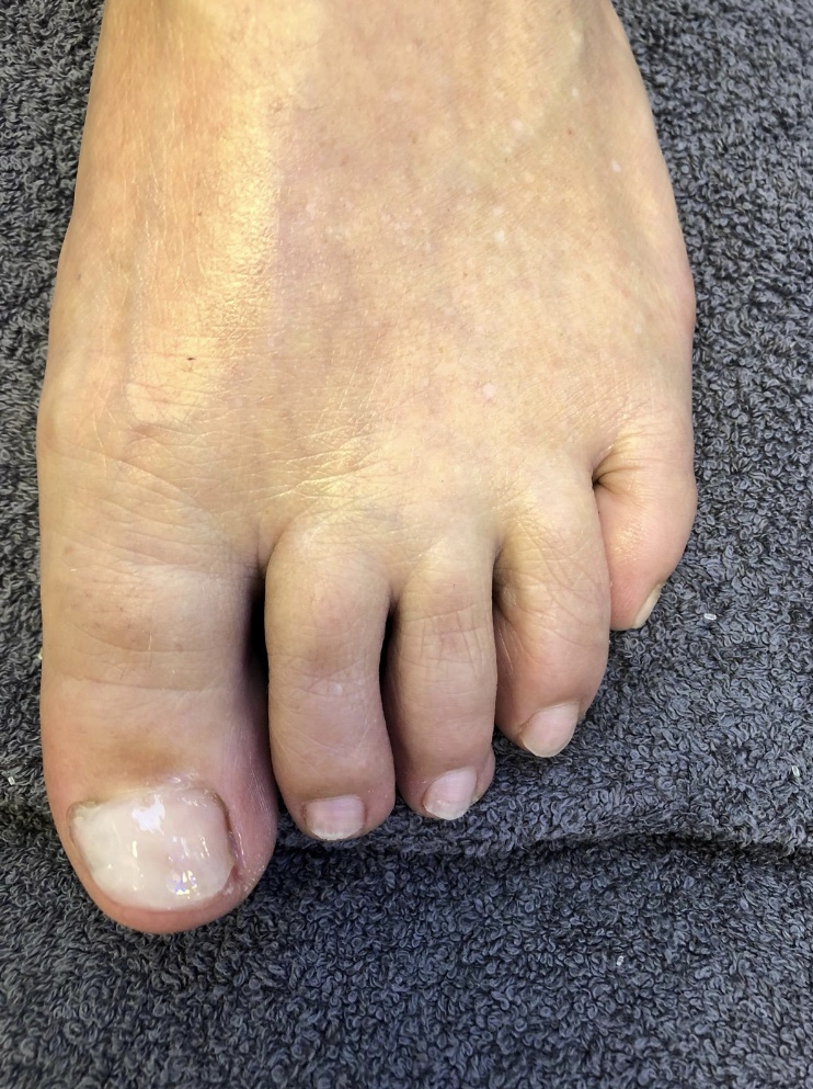 Nail Reconstruction Kent Foot & Ankle Clinic